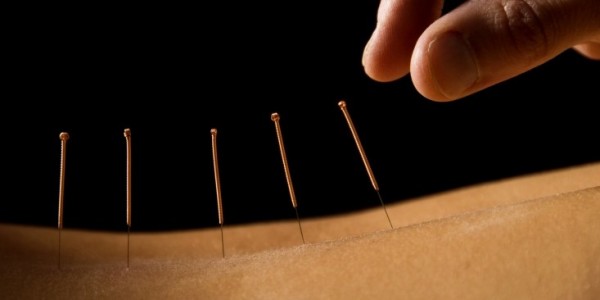 Acupuncture