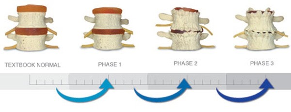 spinal degeneration